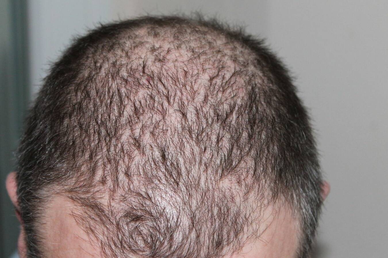 Hair Loss