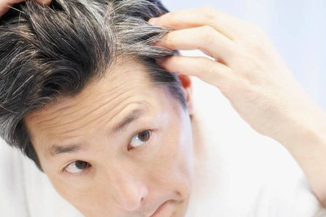 premature-gray-white-hair