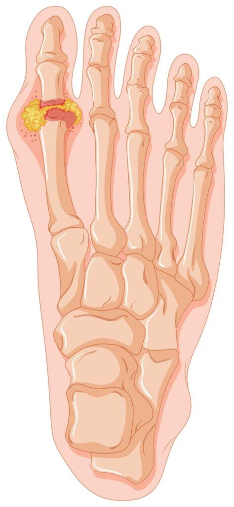 High Uric Acid and Gout Try This Today