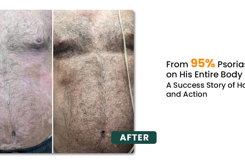 From 95% Psoriasis to 5%–10% on His Entire Body: A Success Story of Hope, Determination and Action