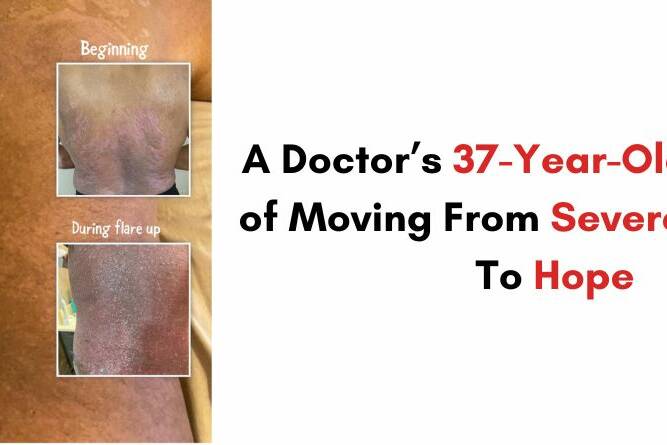 A Doctor’s 37-Year-Old Struggle of Moving From Severe Psoriasis To Hope