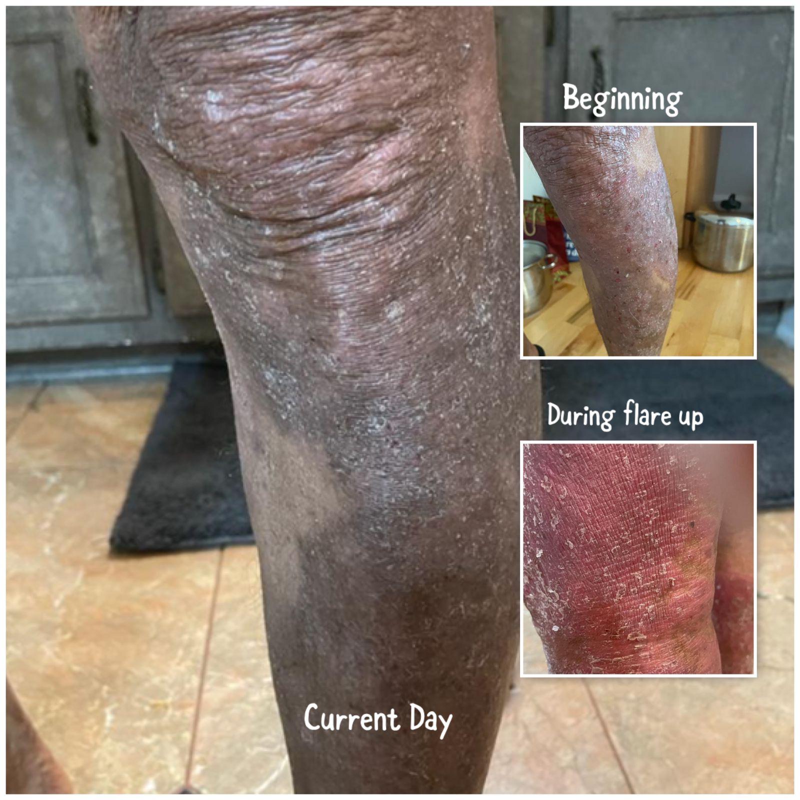 A Doctor’s 37-Year-Old Struggle of Moving From Severe Psoriasis To Hope