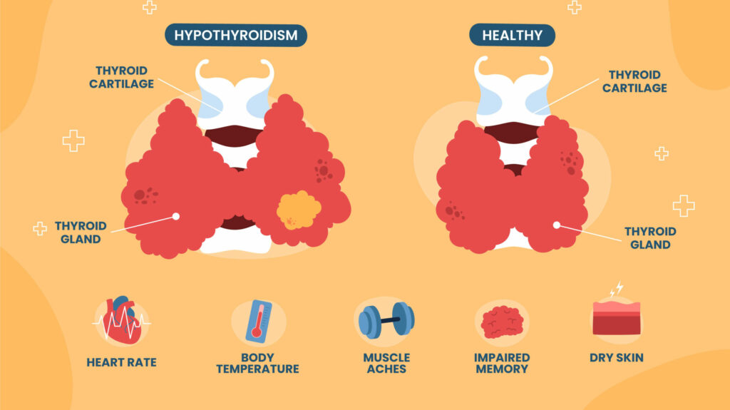 Has Your Thyroid Problem Been Misdiagnosed When It Is Hashimoto's? Read This