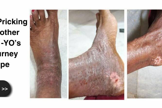 From Needle-Pricking Pain to Smoother Skin: This 71-YO’s eczema Journey Spells Hope