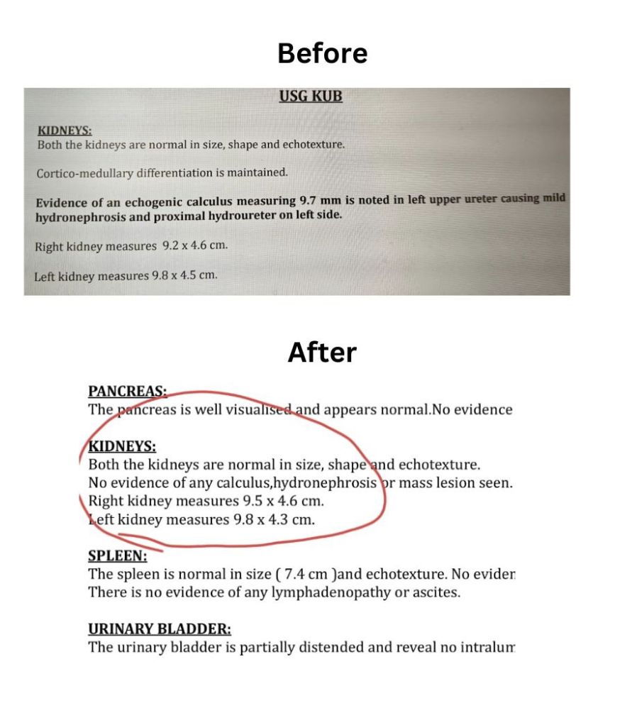 This 57-Year-Old Went From 9.7mm Kidney Stone to None!