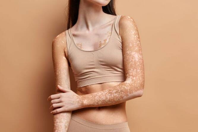 Vitiligo: A Deeper Story Beyond the Skin—Science, Strategies, and Hope for Regaining Skin Health