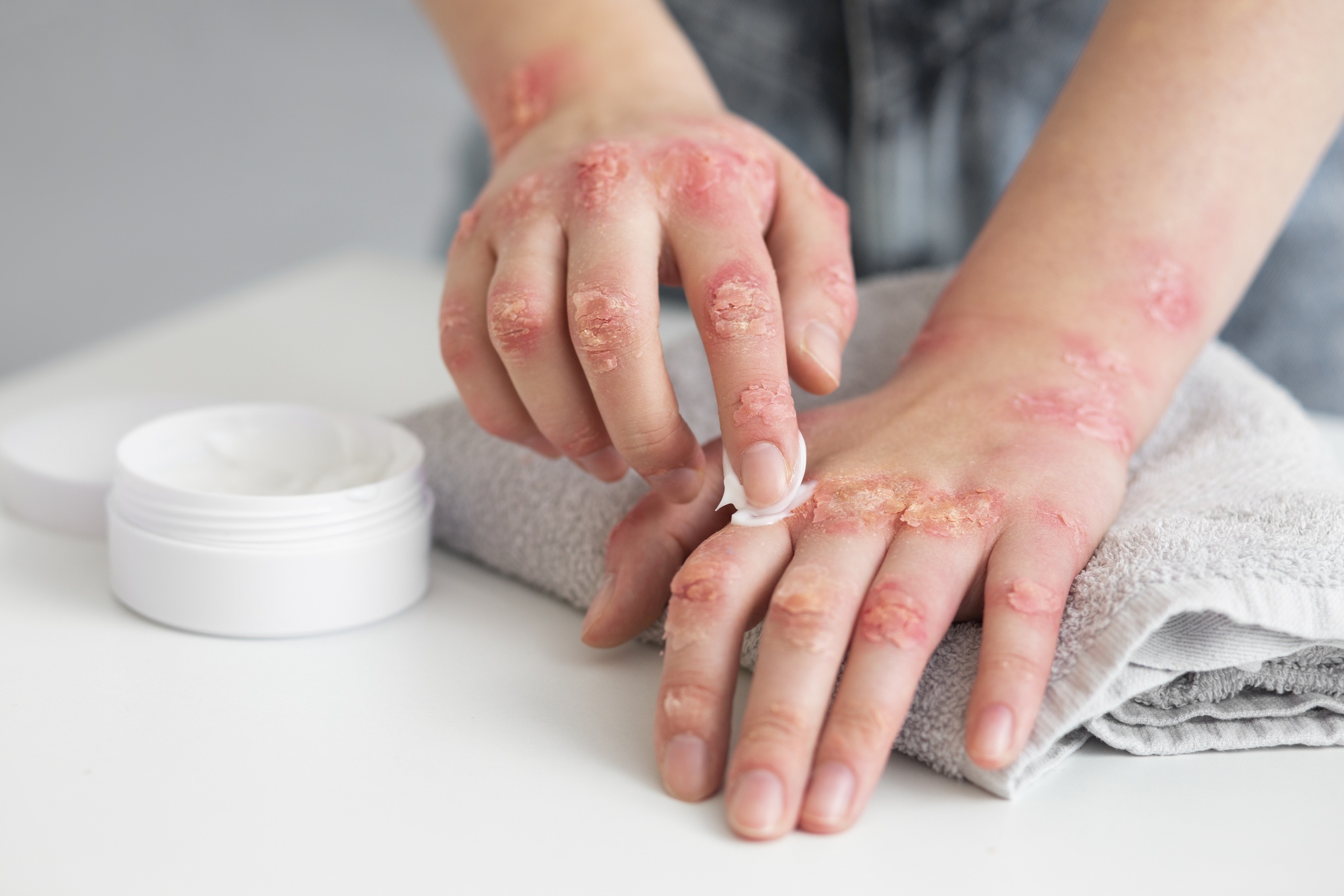 From Flare-Ups to Relief: A Proven Guide to Managing Eczema Naturally