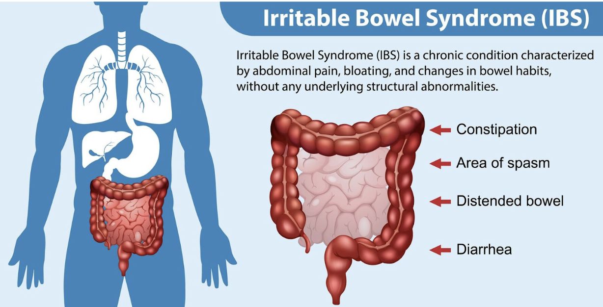 Irritable Bowel Syndrome (IBS): Causes, Symptoms, and Simple Tips for Natural Relief