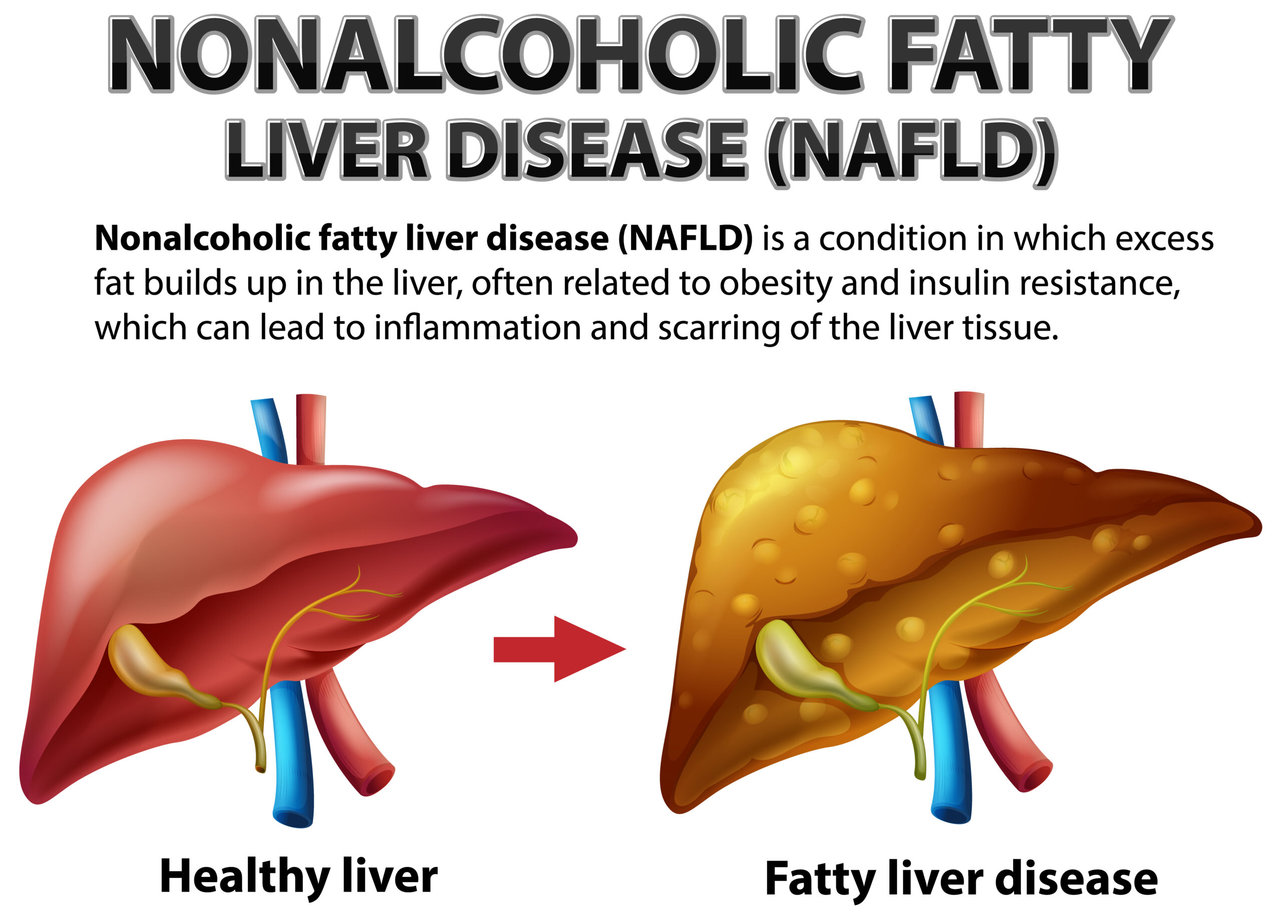 Spotting Symptoms of Nonalcoholic Fatty Liver Disease: The Silent Epidemic Affecting Millions in India